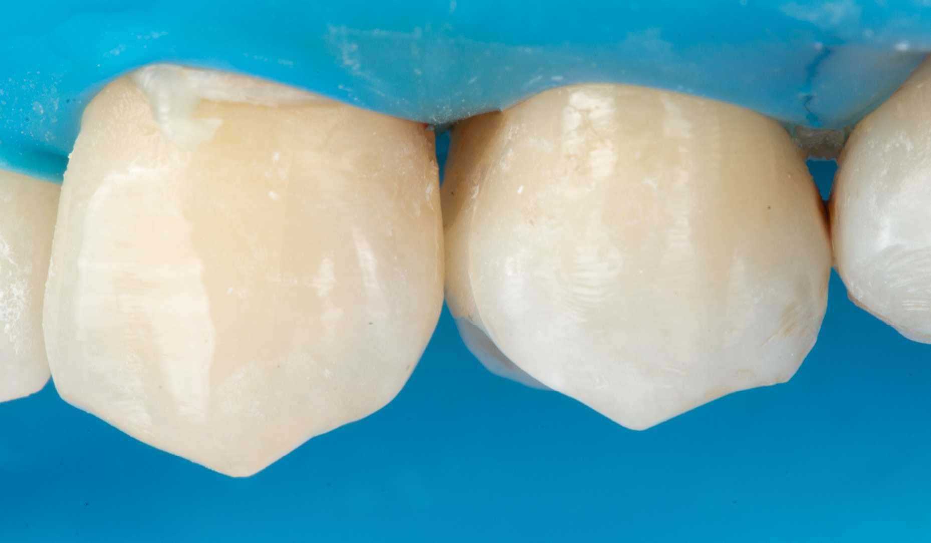 Fig. 8: Buccal view of the teeth restored with a universal-shade flowable composite with super low flowability